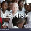 undefined ALBINISM